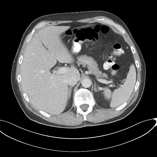 Appendicitis with thickening of the terminal ileum (Radiopaedia 42432-45550 A 25).png