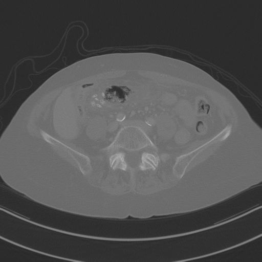 April fools' 2019- calcified peritoneal arachnoidosis (Radiopaedia 67273-76636 Axial bone window 30).png