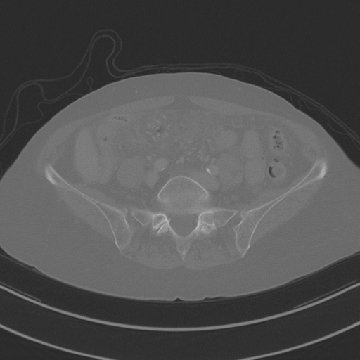 April fools' 2019- calcified peritoneal arachnoidosis (Radiopaedia 67273-76636 Axial bone window 32).png