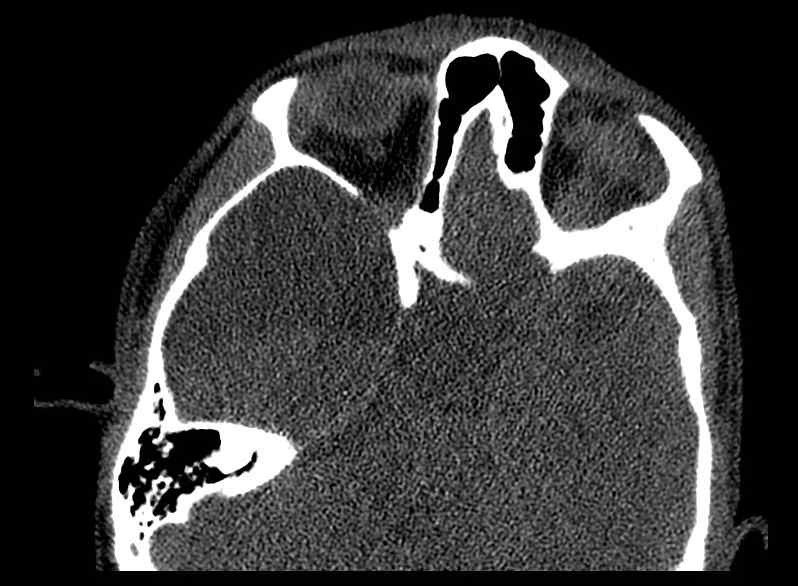 Arachnoid cyst- extremely large (Radiopaedia 68741-78450 Axial bone window 31).jpg