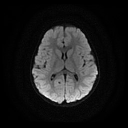 Arachnoid cyst - middle cranial fossa (Radiopaedia 86780-102938 Axial DWI 13).jpg
