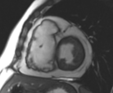 Arrhythmogenic right ventricular cardiomyopathy (Radiopaedia 69431-79307 Short axis cine 132).jpg