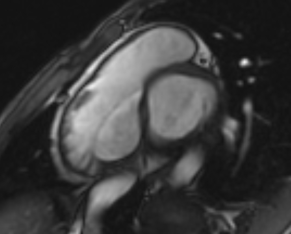 Arrhythmogenic right ventricular cardiomyopathy (Radiopaedia 69564-79464 short axis cine 235).jpg