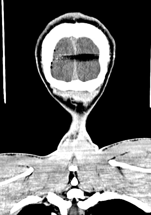 Arrow injury to the brain (Radiopaedia 72101-82607 Coronal non-contrast 67).jpg