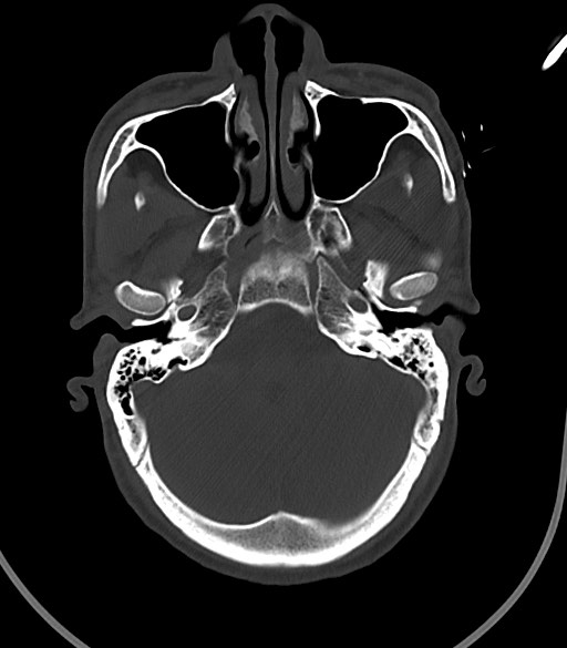 Arrow injury to the face (Radiopaedia 73267-84011 Axial bone window 45).jpg