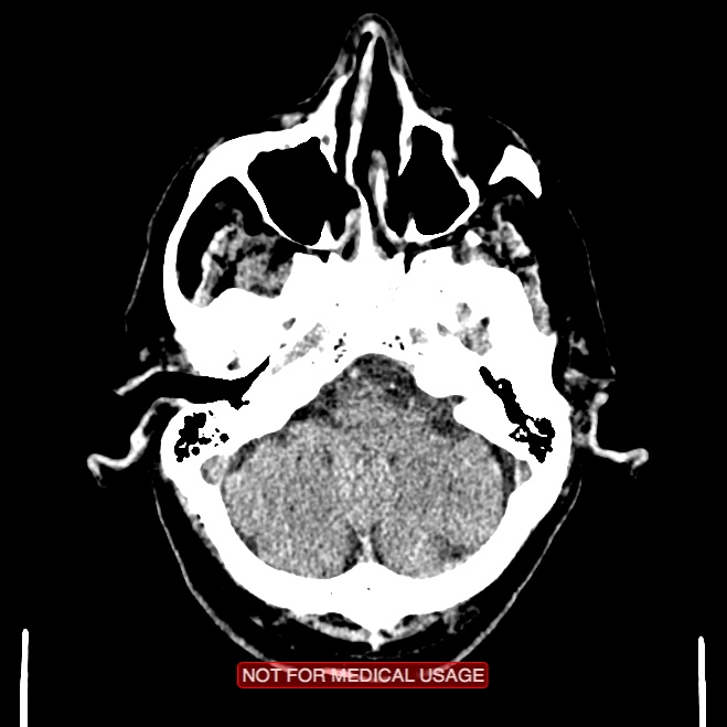 Artery of Percheron infarction (Radiopaedia 28679-28967 Axial non-contrast 25).jpg