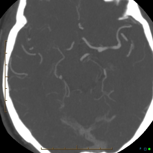 File:Artifactual basilar artery stenosis due to metallic stent (Radiopaedia 31206-31923 A 19).jpg