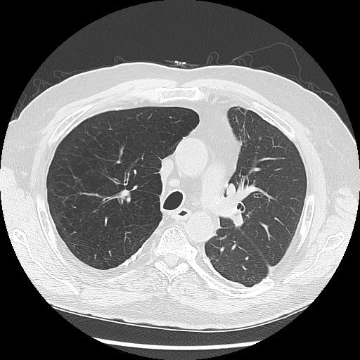Asbestos-related pleural disease (Radiopaedia 74366-85250 Axial lung window 44).jpg