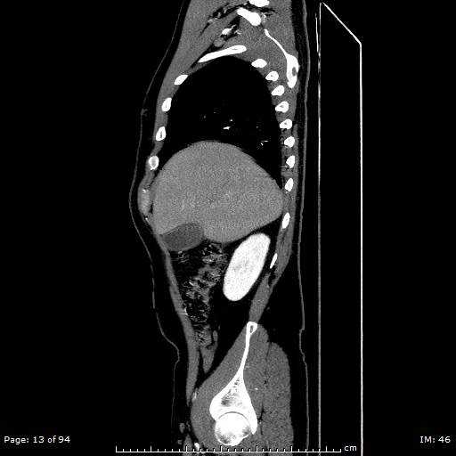 Ascending aortic aneurysm (Radiopaedia 50086-55404 C 10).jpg