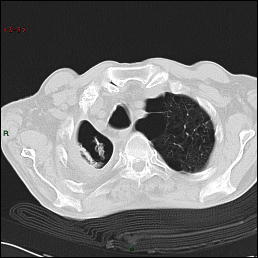 File:Aspergilloma (Radiopaedia 14842-14787 Axial lung window 8).jpg