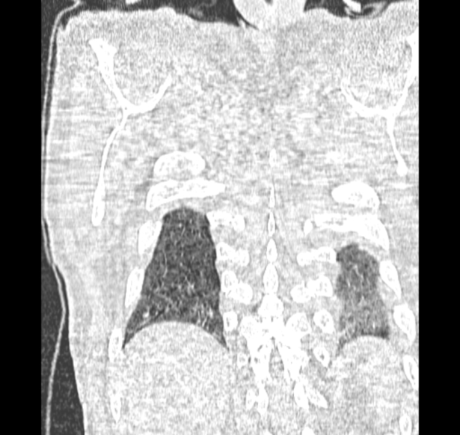 Aspergilloma (Radiopaedia 44592-48327 Coronal lung window 124).jpg
