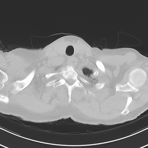 Aspergilloma on background pulmonary fibrosis (Radiopaedia 60942-68757 A 3).jpg
