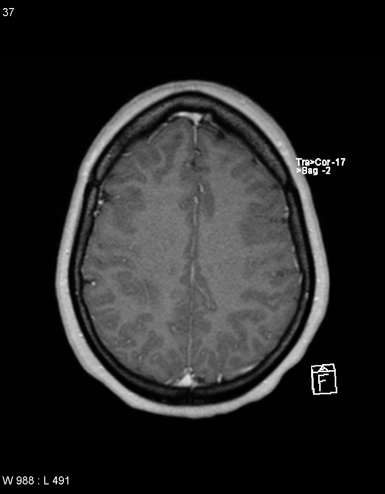 Astroblastoma (Radiopaedia 39792-42217 Axial T1 C+ 36).jpg