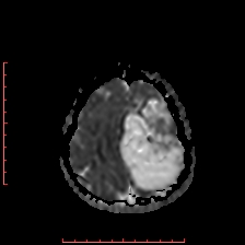File:Astroblastoma (Radiopaedia 74287-85162 Axial ADC 58).jpg