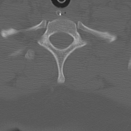 Atlanto-occipital dissociation (Radiopaedia 33848-35013 Axial bone window 44).png