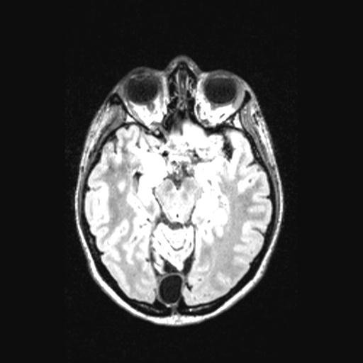Atretic encephalocoele with inferior vermis hypoplasia (Radiopaedia 30443-31108 Axial 66).jpg