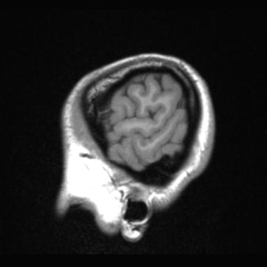 File:Atretic encephalocoele with inferior vermis hypoplasia (Radiopaedia 30443-31108 Sagittal T1 7).jpg