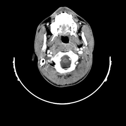 File:Atypical 2nd branchial cleft cyst (type IV) - infected (Radiopaedia 20986-20924 A 3).jpg