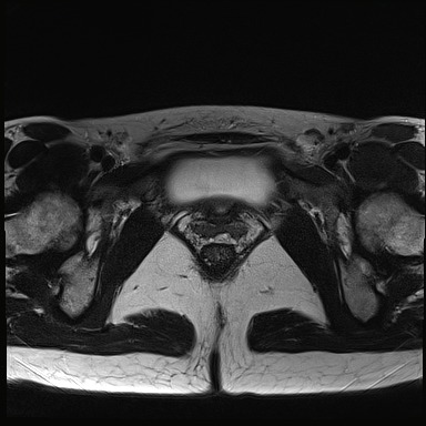 File:Atypical deep infiltrating endometriosis (Radiopaedia 44470-48125 Axial T2 26).jpg