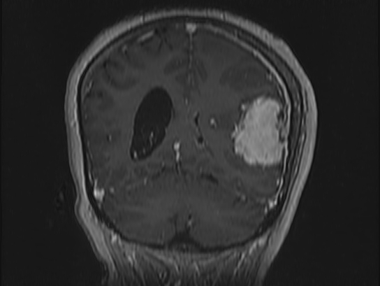 Atypical meningioma (Radiopaedia 62985-71406 Coronal T1 C+ 91).jpg