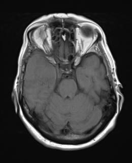 File:Atypical meningioma (WHO Grade II) (Radiopaedia 54742-60979 Axial T1 9).png