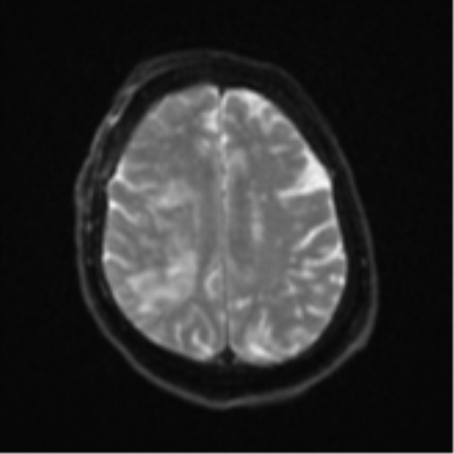 File:Atypical meningioma (WHO Grade II) (Radiopaedia 54742-60981 Axial DWI 20).png
