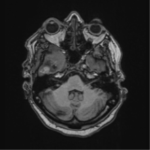 Atypical meningioma (WHO Grade II) (Radiopaedia 54742-60981 Axial T1 16).png