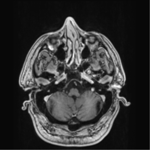 Atypical meningioma (WHO grade II) with brain invasion (Radiopaedia 57767-64729 Axial T1 C+ 8).png