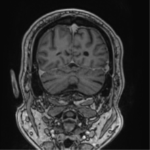 Atypical meningioma (WHO grade II) with brain invasion (Radiopaedia 57767-64729 Coronal T1 C+ 70).png
