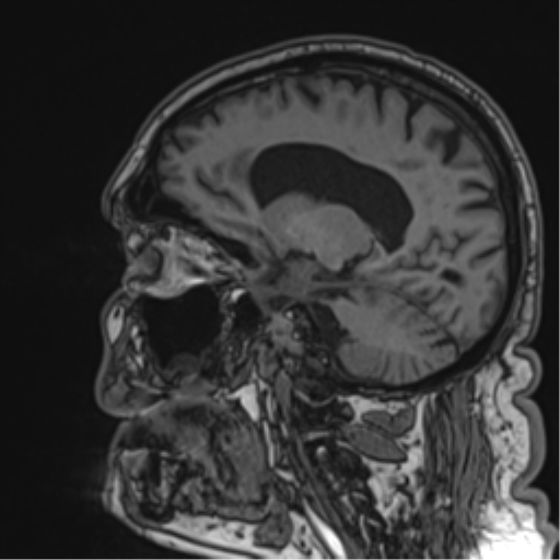 Atypical meningioma (WHO grade II) with brain invasion (Radiopaedia 57767-64729 Sagittal T1 30).png