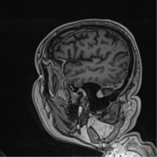 Atypical meningioma (WHO grade II) with brain invasion (Radiopaedia 57767-64729 Sagittal T1 C+ 19).png