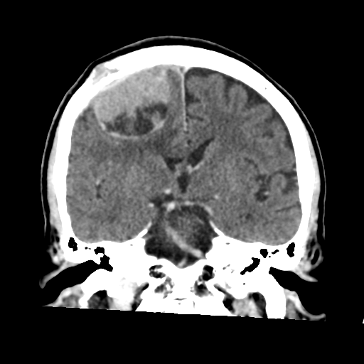 Atypical meningioma (WHO grade II) with osseous invasion (Radiopaedia 53654-59715 Coronal C+ delayed 31).png