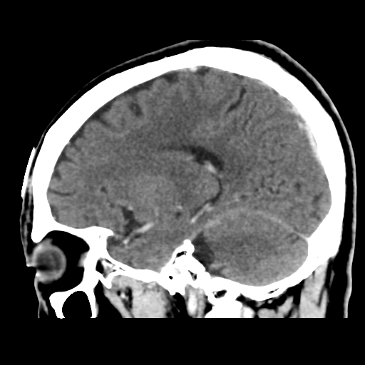 File:Atypical meningioma (WHO grade II) with osseous invasion (Radiopaedia 53654-59715 G 35).png