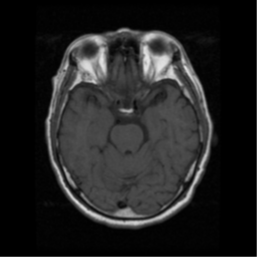 File:Atypical meningioma (WHO grade II) with osseous invasion (Radiopaedia 53654-59716 Axial T1 8).png