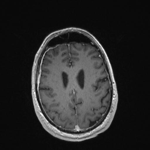 Atypical meningioma (grade II) - en plaque (Radiopaedia 29633-30147 Axial T1 C+ 132).jpg