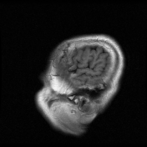 File:Atypical meningioma with skull invasion (Radiopaedia 34357-35648 Sagittal T1 21).png