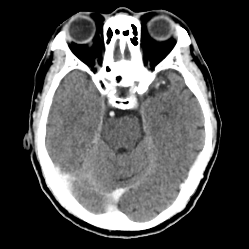 Atypical meningioma with skull invasion (Radiopaedia 34357-35649 Axial C+ delayed 20).png