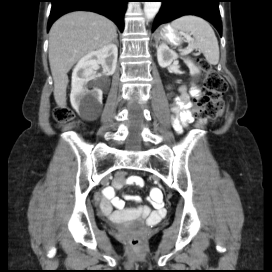 File:Atypical renal cyst (Radiopaedia 17536-17251 C 13).jpg