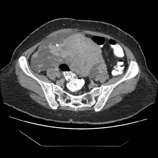 File:Atypical retroperitoneal lymphocoeles with large leiomyoma of uterus (Radiopaedia 32084-33024 A 28).jpg