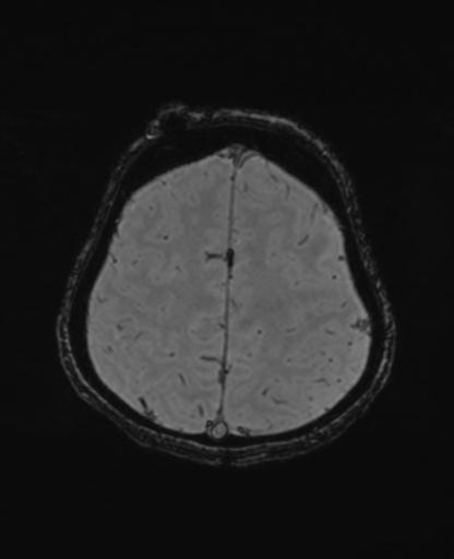Autoimmune limbic encephalitis (Radiopaedia 30363-31005 SWI - magnitude 64).jpg