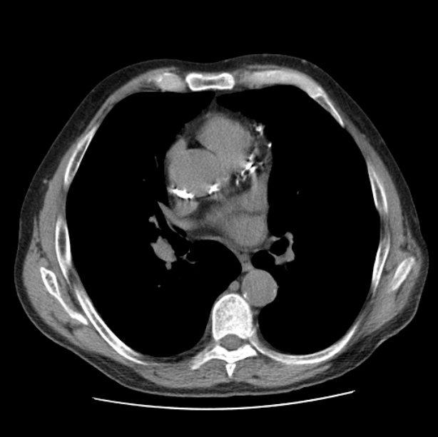 Autosomal dominant polycystic kidney disease (Radiopaedia 27851-28094 Axial non-contrast 29).jpg