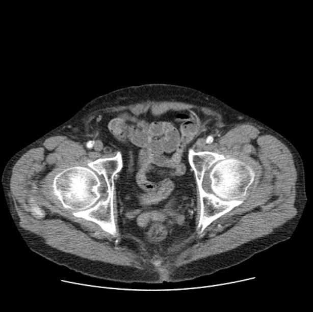 Autosomal dominant polycystic kidney disease (Radiopaedia 27851-28094 B 115).jpg