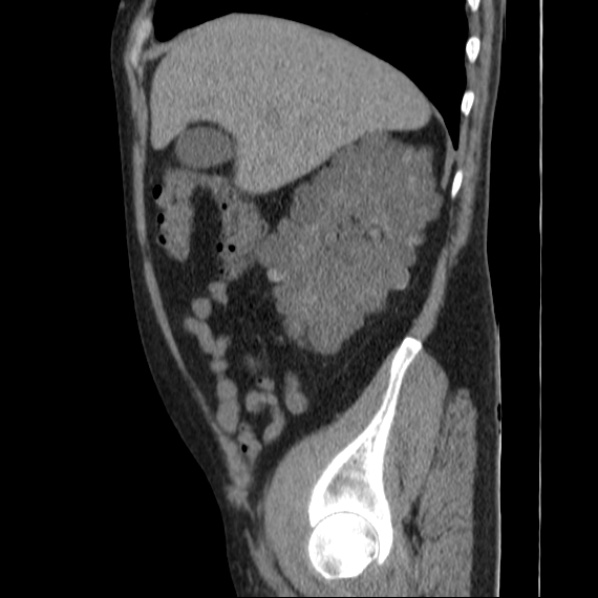 Autosomal dominant polycystic kidney disease (Radiopaedia 36539-38101 D 23).jpg
