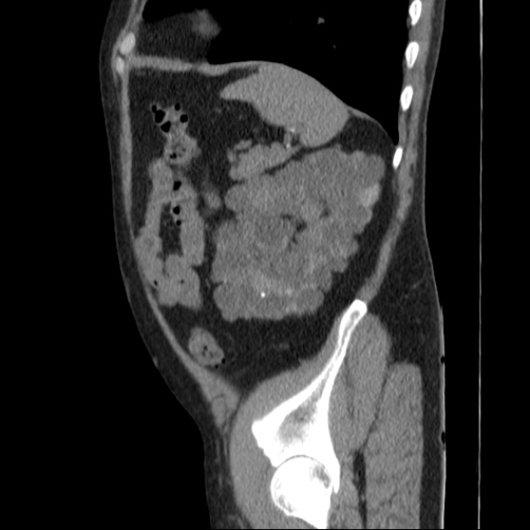 Autosomal dominant polycystic kidney disease (Radiopaedia 36539-38101 D 65).jpg