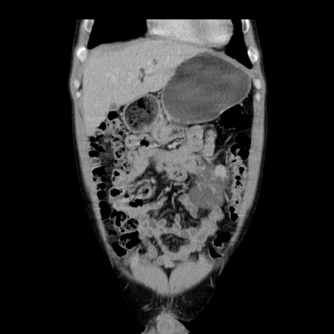 Autosomal dominant polycystic kidney disease (Radiopaedia 66349-75582 A 10).jpg