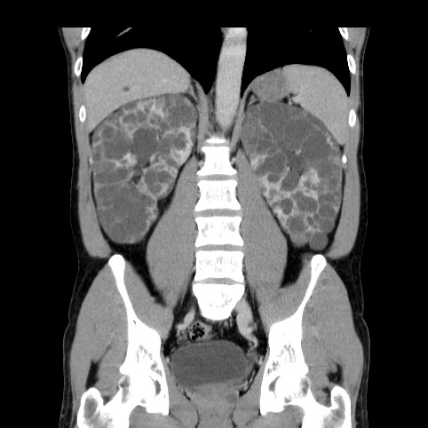 File:Autosomal dominant polycystic kidney disease (Radiopaedia 66349-75582 A 55).jpg