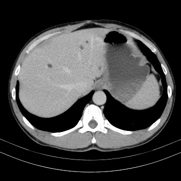 Autosomal dominant polycystic kidney disease (Radiopaedia 66349-75582 B 13).jpg