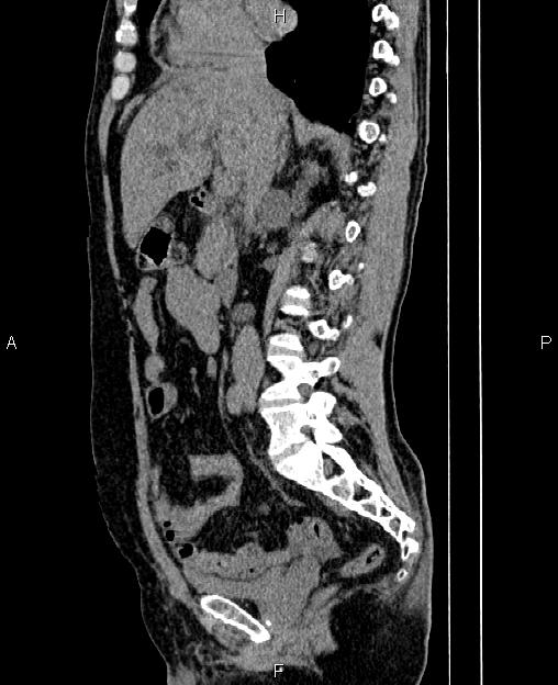 Autosomal dominant polycystic kidney disease (Radiopaedia 87830-104287 C 39).jpg