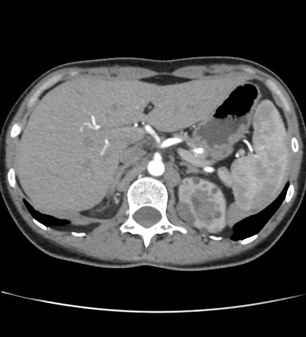 Autosomal dominant polycystic kidney disease - early onset (Radiopaedia 40734-43387 B 4).jpg