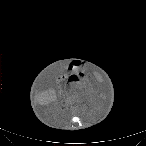 Autosomal recessive polycystic kidney disease associated with Caroli disease (Radiopaedia 61932-69984 Axial non-contrast 210).jpg